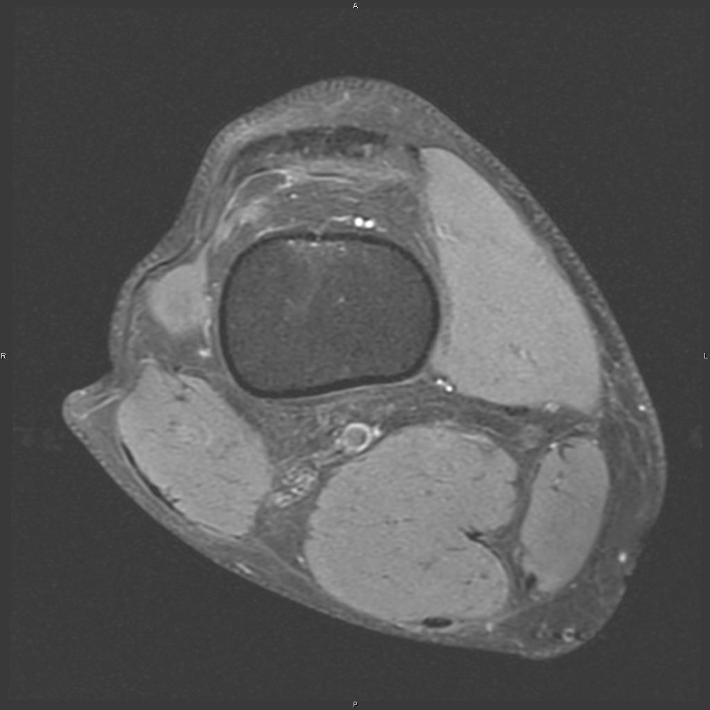 MRI Knee Axial View