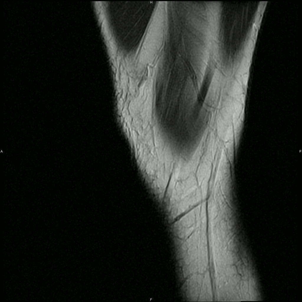MRI Knee Sagital View
